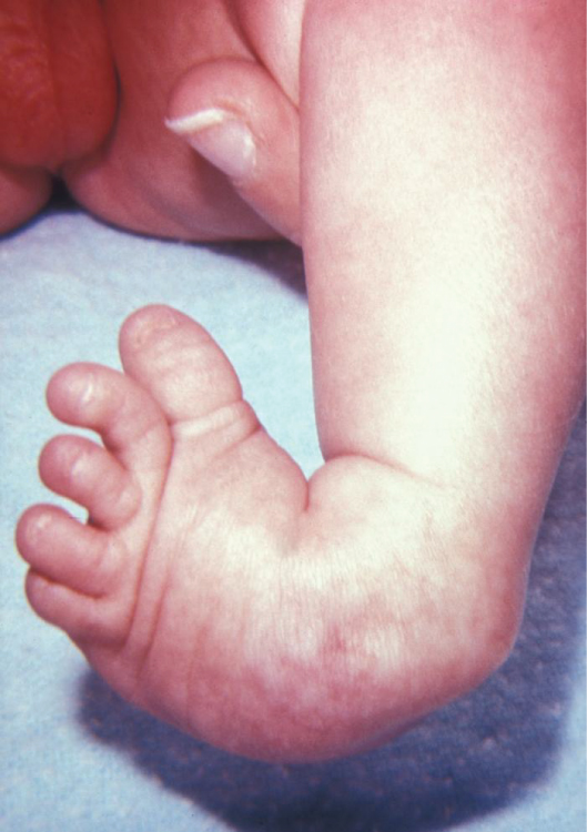 Example of a congenital multifactorial defect: clubfoot