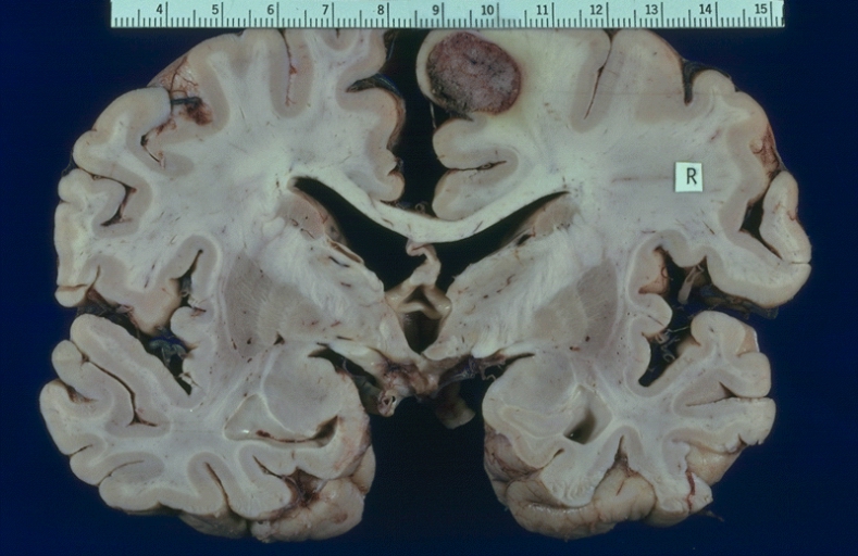 THYROID PAPILLARY CARCINOMA METASTATIC TO BRAIN.