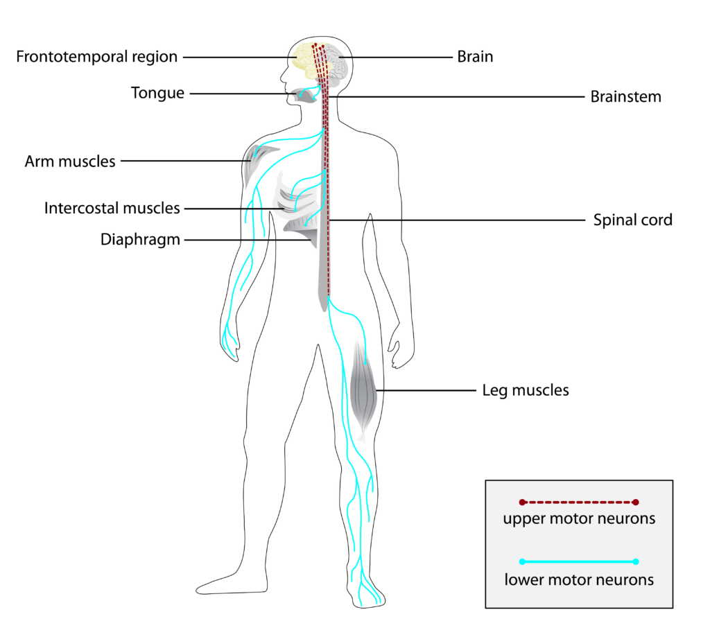 Example of abnormal protein preparation: ALS