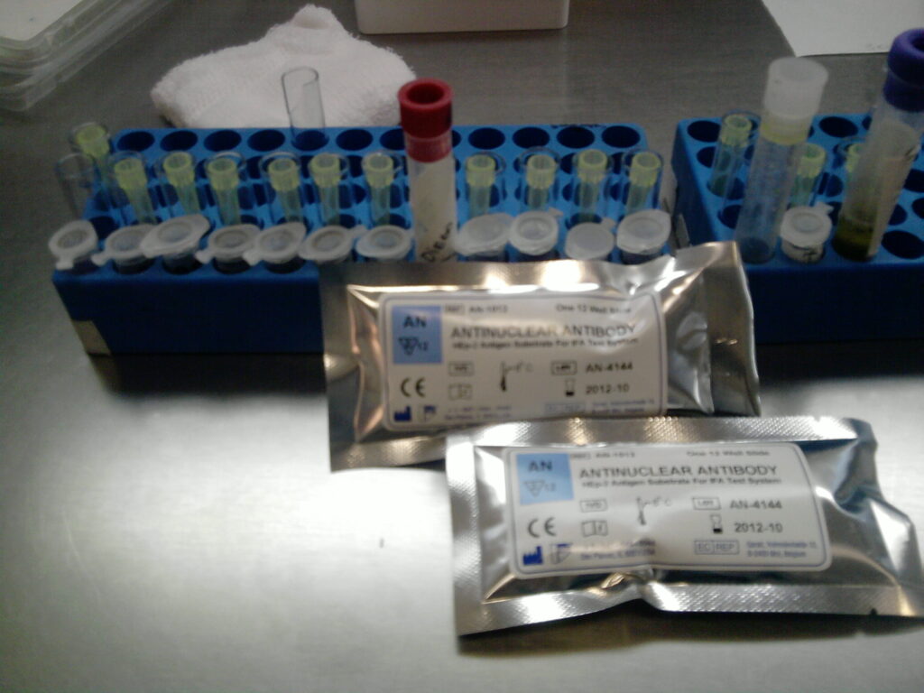 Common autoimmune disease diagnostic tool: antinuclear antibody