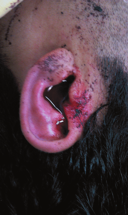Active otorrhagia from the left ear Figure 2: Dead leech after removal.