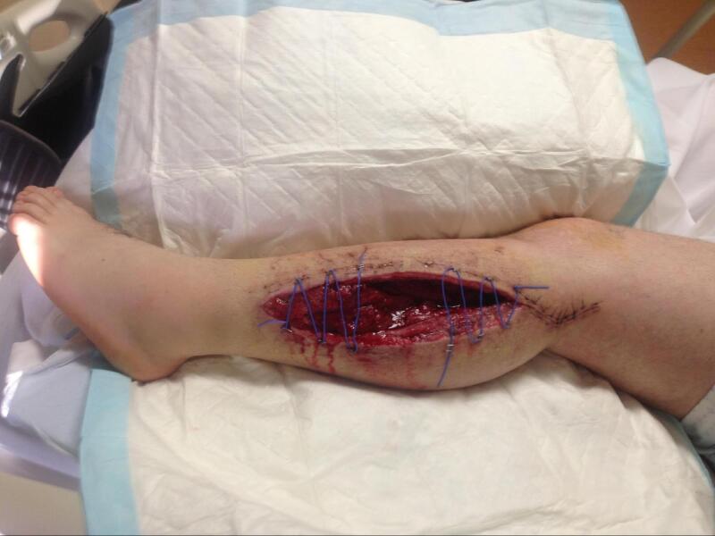 Acute Compartment Syndrome