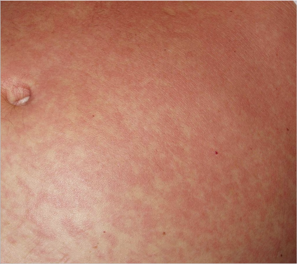 The standard clinical manifestations of acute African trypanosomiasis include a "trypanid rash", small pink-spotted rash on the abdomen.
