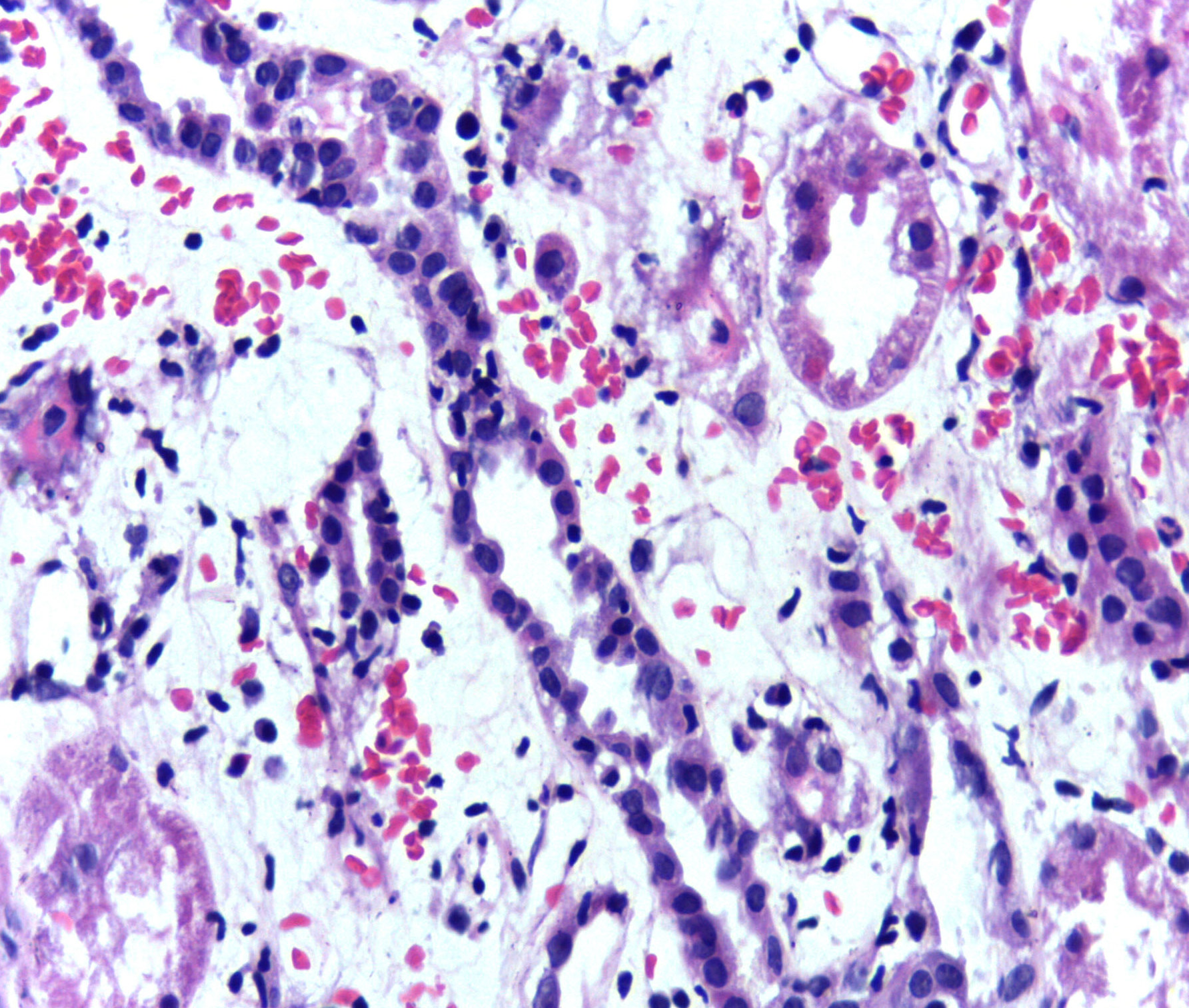 Presence of lymphocytes within tubular epithelium (tubulitis) in the kidney is one of the pathological features of acute rejection following renal transplant.