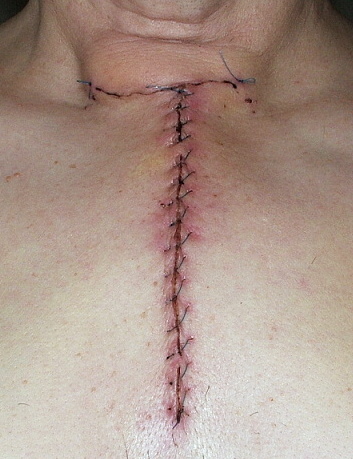 Myasthenia graves: treatment