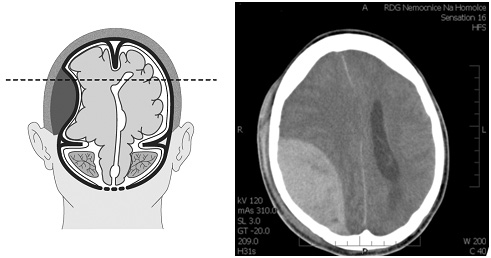 Acute Epidural Hematoma.