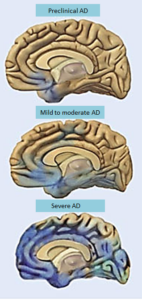 Alzheimers disease progression-brain degeneration.