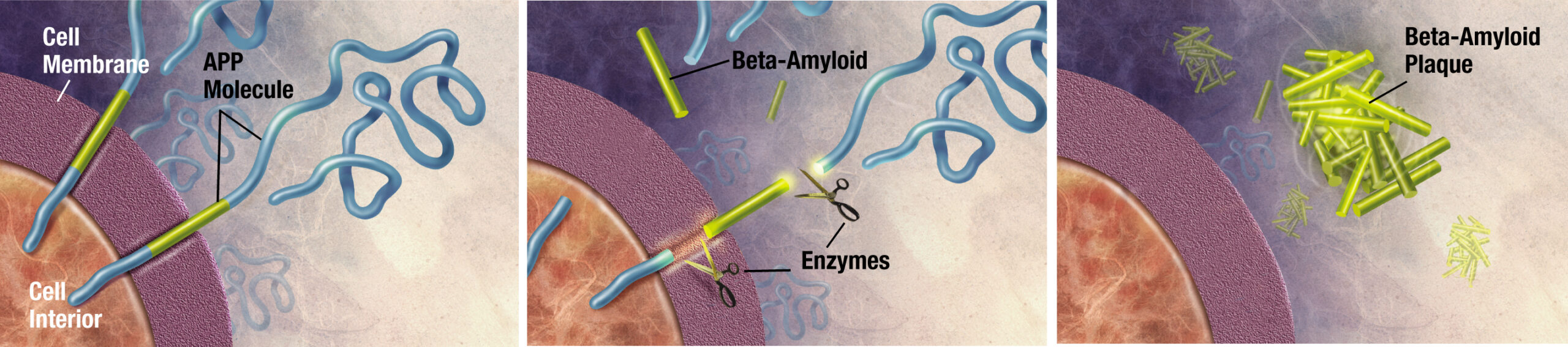 Amyloid Plaque Formation.