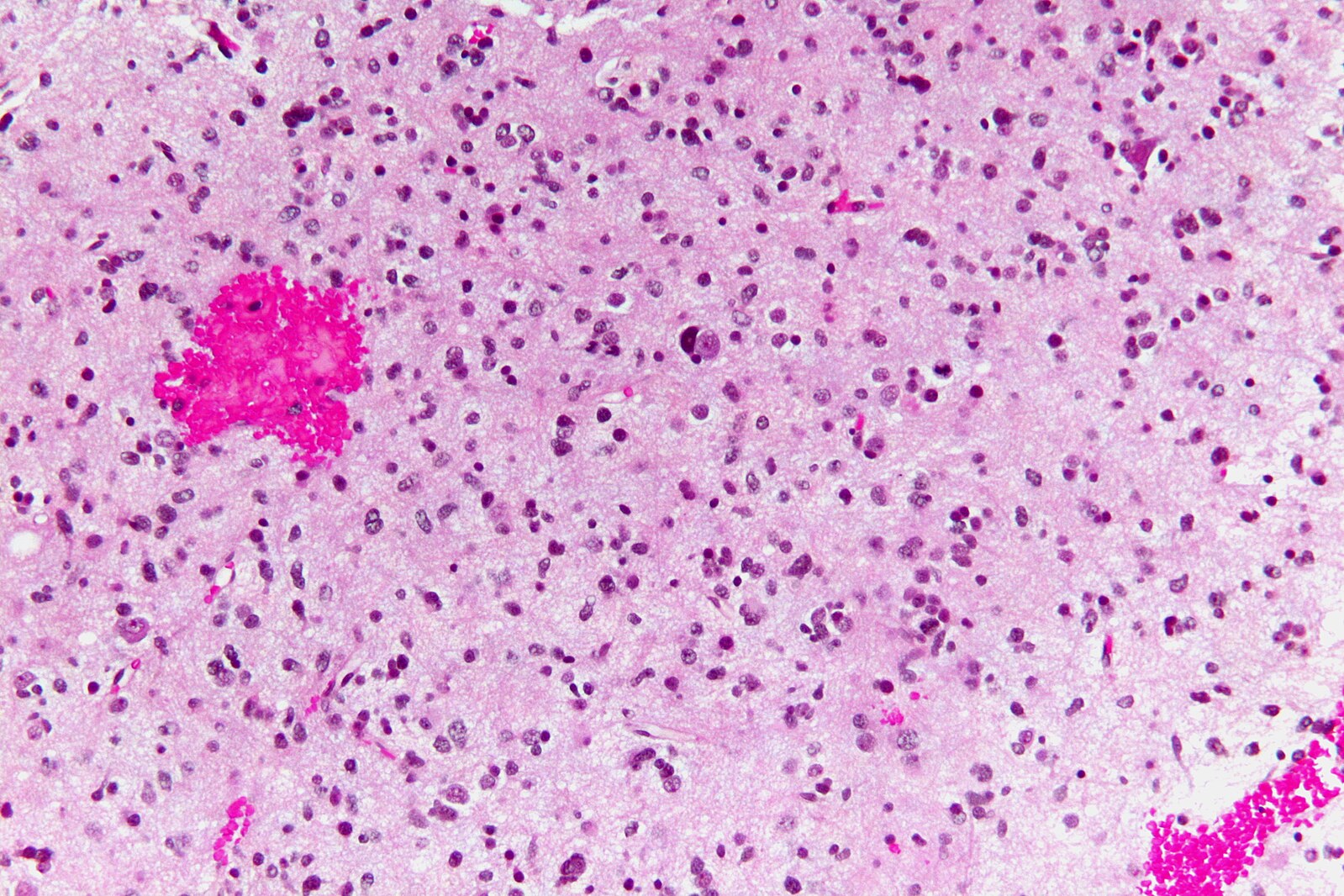 Anaplastic astrocytoma - high mag.