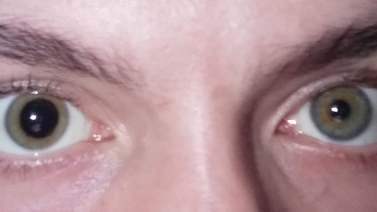 Anisocoria.