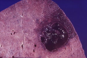 Example of liquefactive necrosis