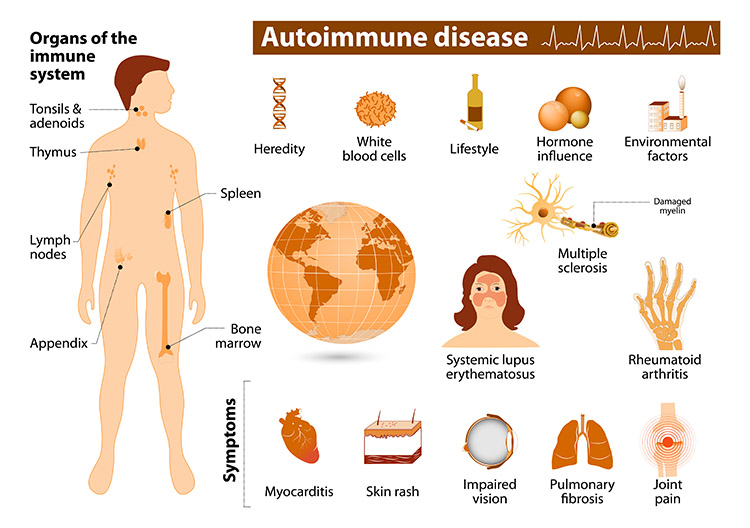 Example of immune diseases
