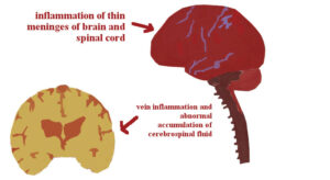 Bacterial Meningitis.
