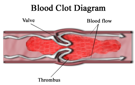 Blood clot diagram