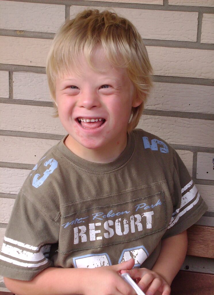 Example of a congenital multifactorial defect: Down syndrome