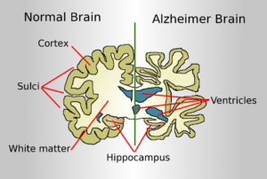 Drawing comparing how a brain of an Alzheimer disease patient is affected to a normal brain.