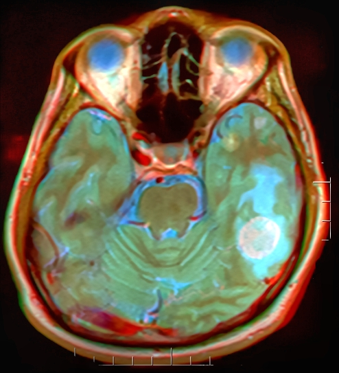 Brain MRI 141752 rgbc CE.