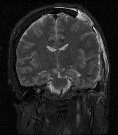 Brain herniation MRI.