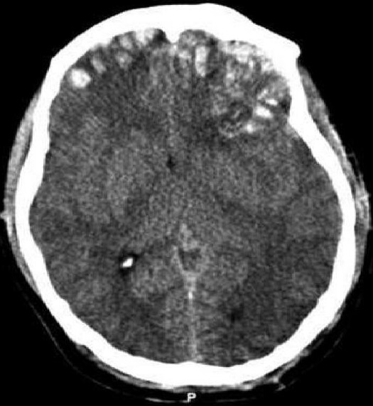 Brain trauma CT.