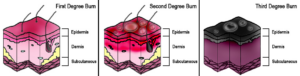First, second, and third degree burn tissue damage. First degree burns only affect the epidermis (outer layer of skin). There are no blisters, but the skin will appear red, itchy, and dry. Second degree burns affect the epidermis and the inner dermis. The skin will be blistered, swollen, painful, red, white, or splotchy. Third degree burns destroy the epidermis, the entire dermis, and reach the subcutaneous layer. Skin will appear swelling, dry, black, white, brown, or yellowing. Nerve endings are are commonly destroyed with third degree burns, therefore the patient often experiences a lack of pain.