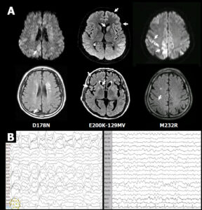 CJD profiles of MRI and EEG from probable CJD patient.