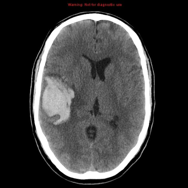 CT brainAVM non-contrast hematoma.