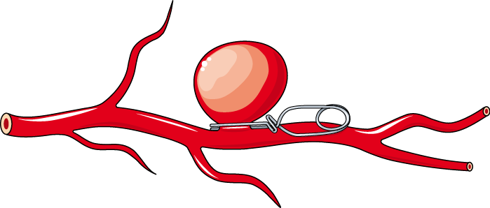 Cardiovascular system - Aneurysm clip -- Smart-Servier.