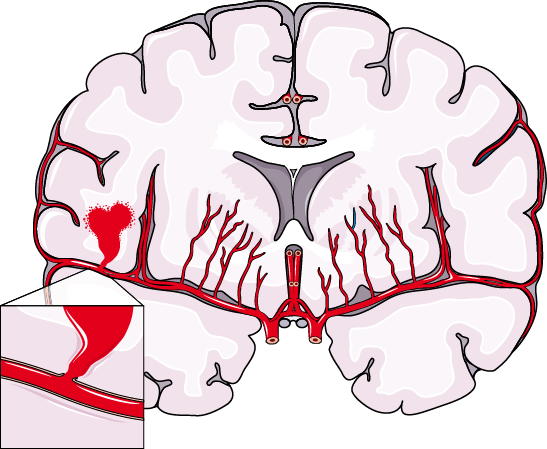 Hemorrhagic Stroke