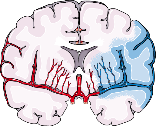 Ischemic Stroke