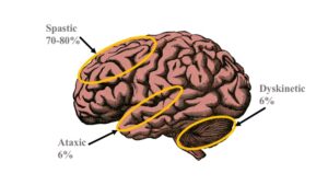 Cerebral Palsy Types.