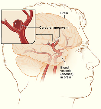 Cerebral aneurysm.