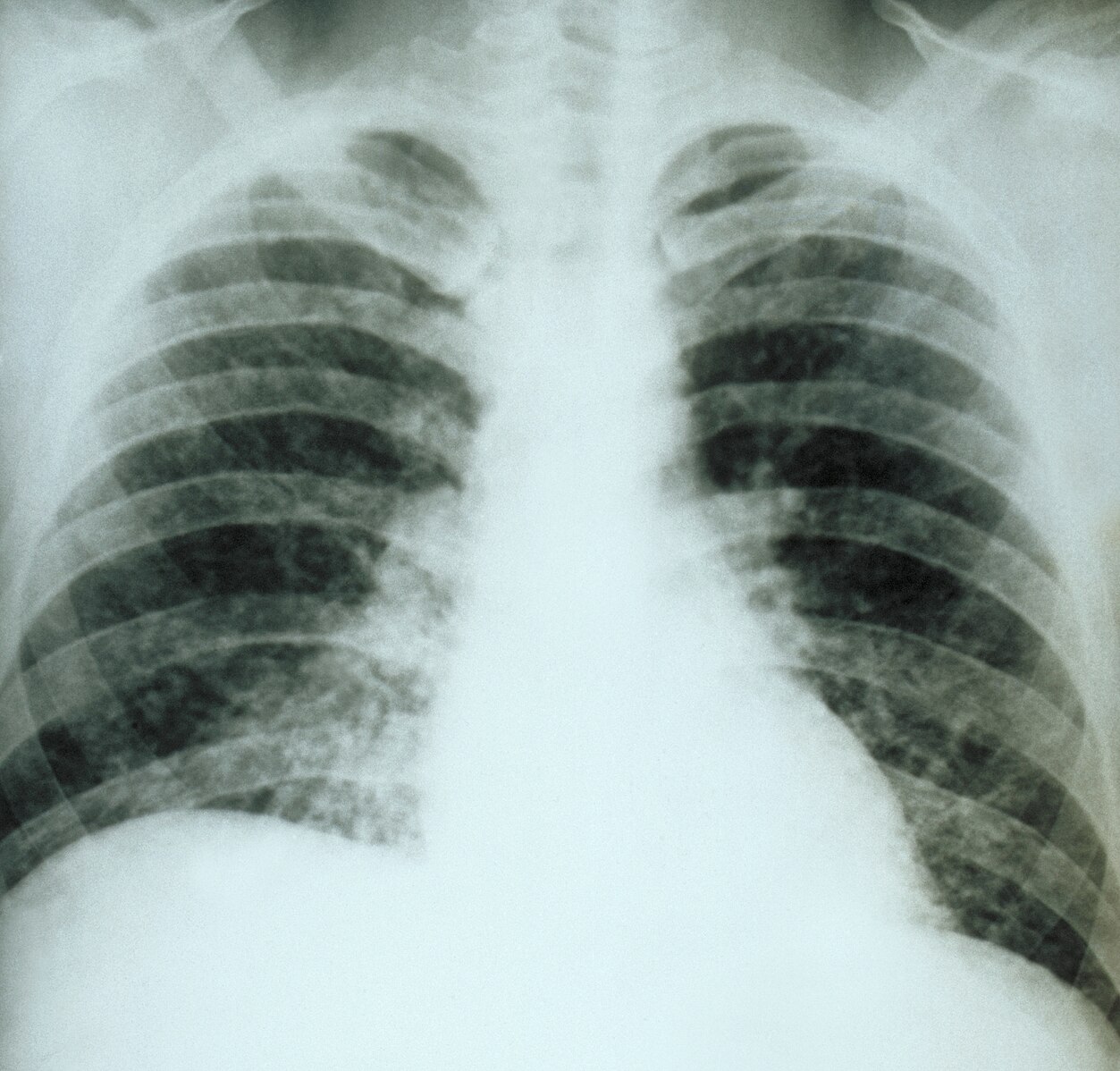 Chest X-ray (Acute Pulmonary Histoplasmosis)
