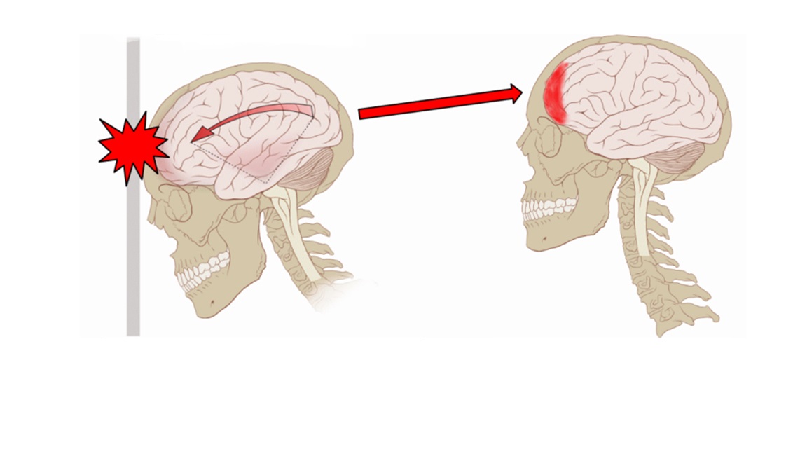 Closed Head Injury, Closed Brain Injury.