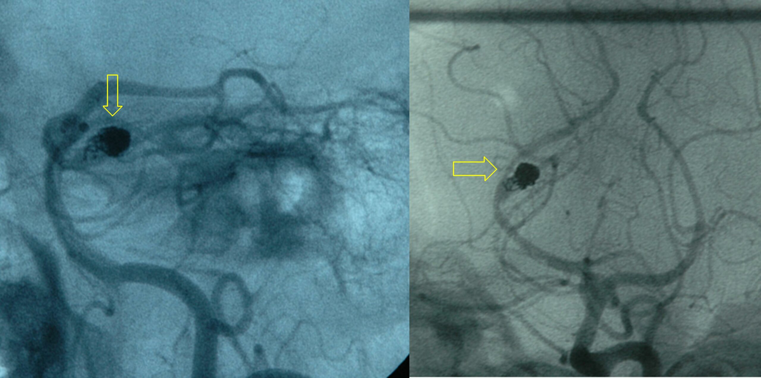 Coiled PCA residual aneurysm arteriogram.