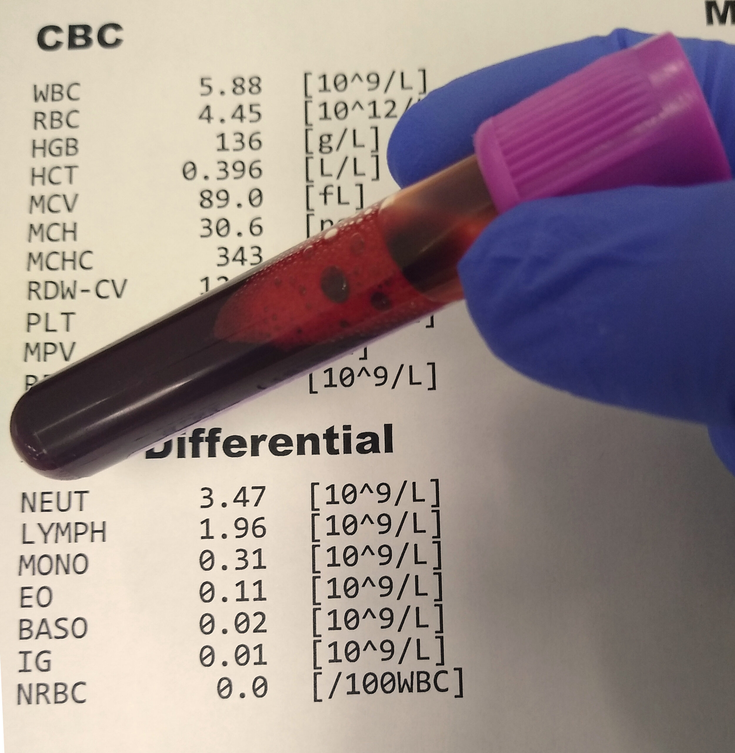 Complete blood count and differential - diagnostic test for autoimmune disease