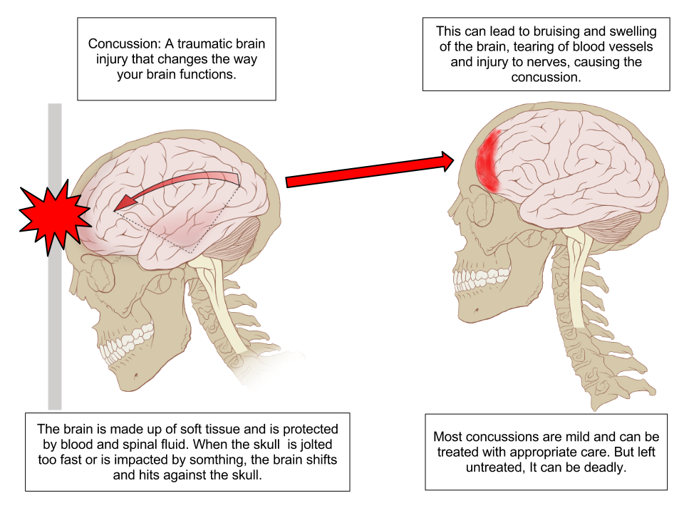 Concussion Anatomy