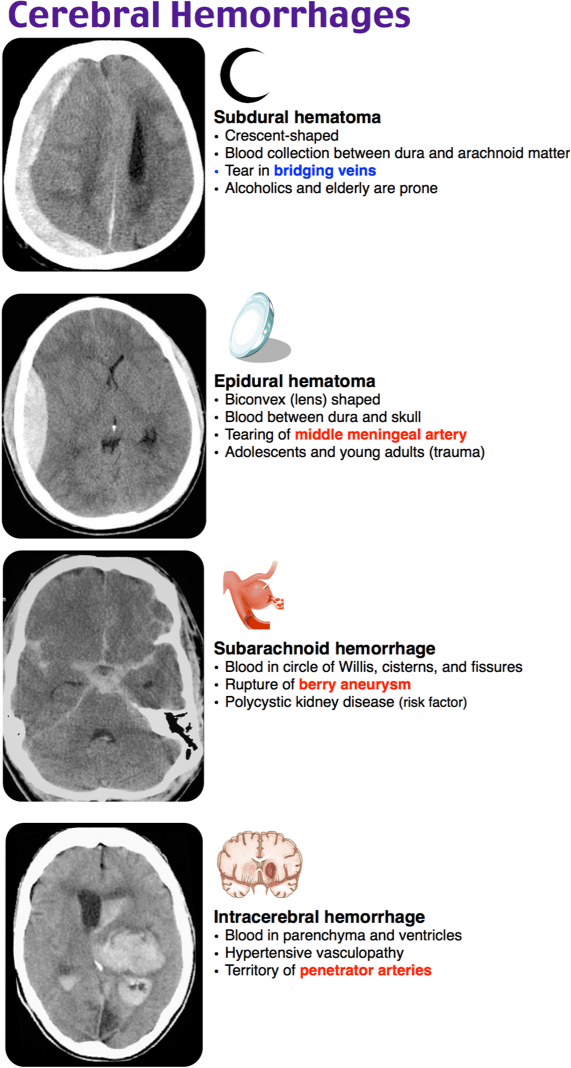 Craniocerebral hematoma.