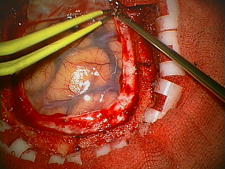 Craniotomy Arachnoid.