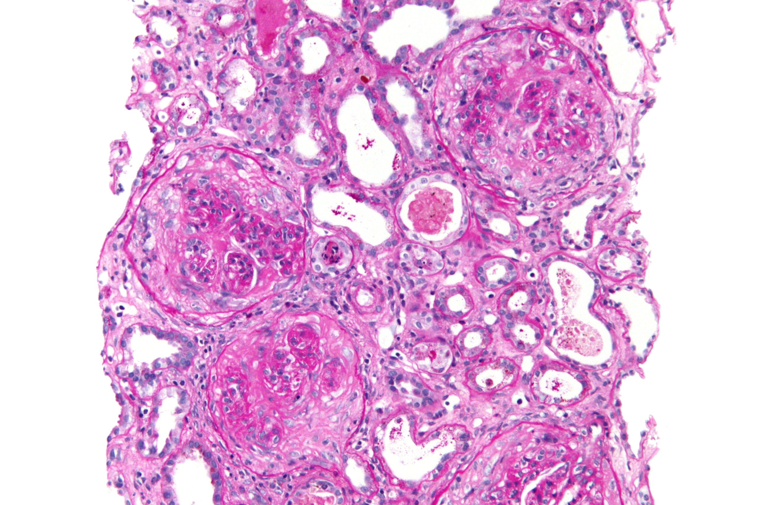 rapidly progressive glomerulonephritis