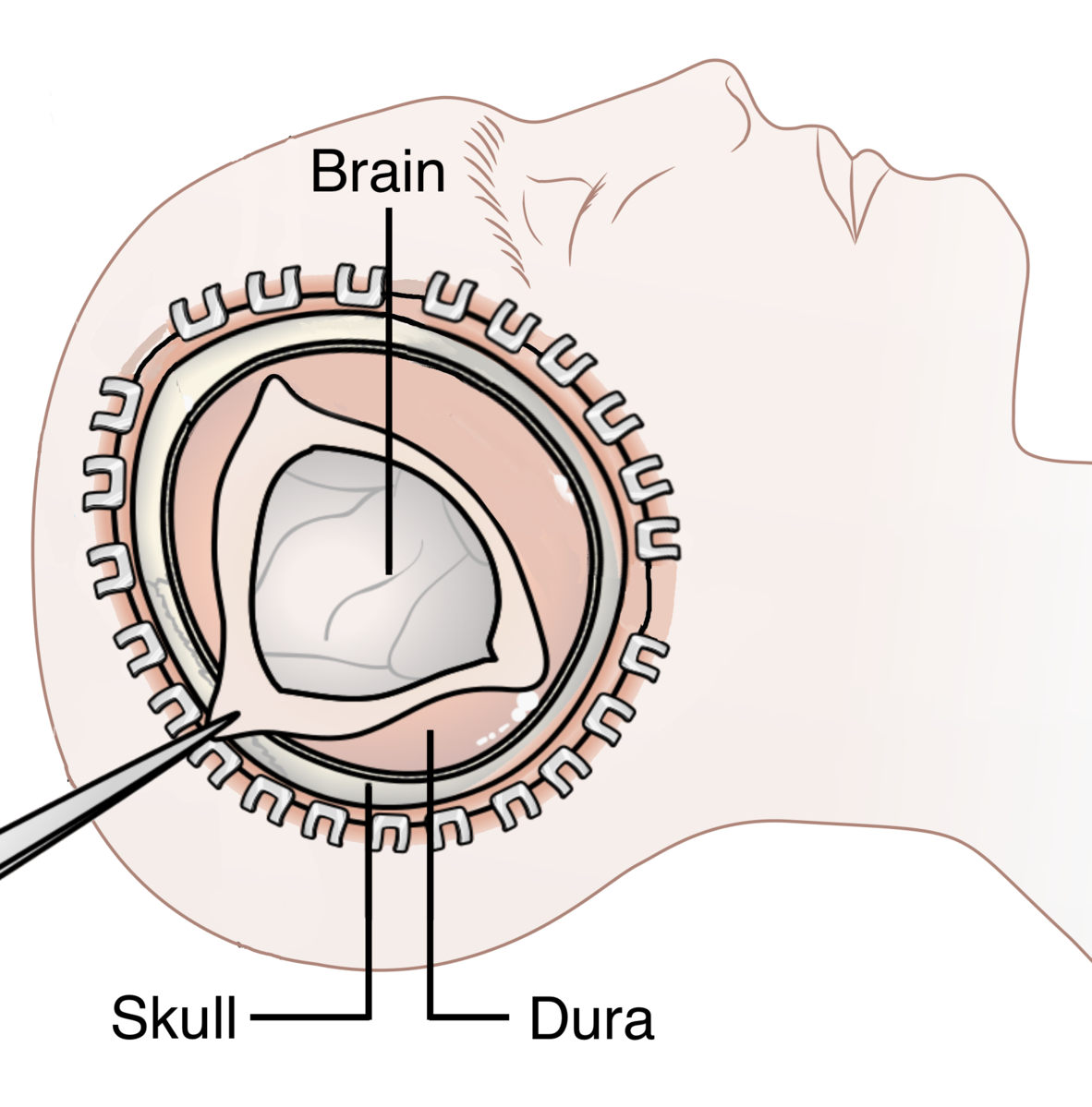 Decompressive Craniectomy