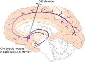 Deep Brain Stimulation (DBS) of Nucleus Basalis of Meynert (NBM) in Dementia with Lewy Bodies (DLB)