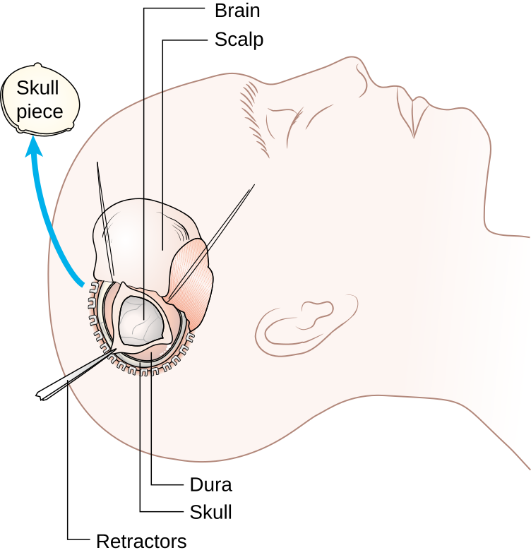 Diagram showing a craniotomy CRUK 063.