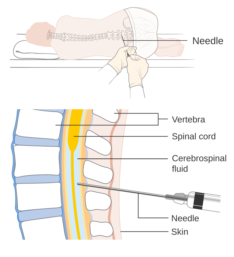 Diagram showing how you have a lumbar puncture.