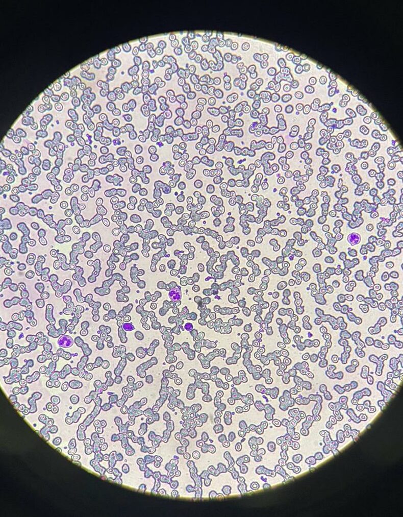 A differential count measures the percentages of each type of leukocyte present in a blood sample