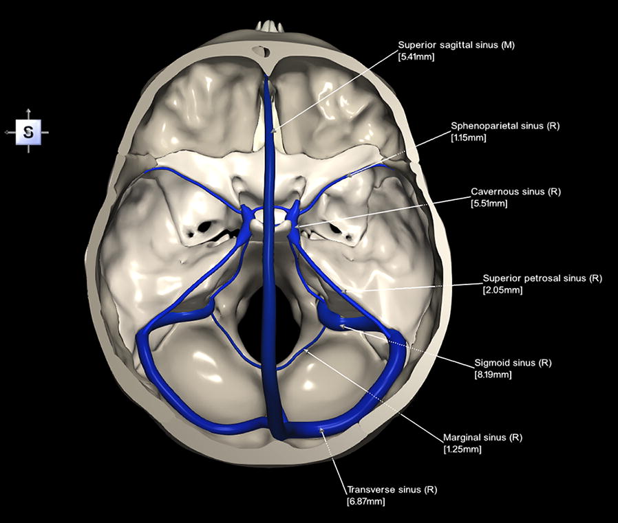 Dural Sinuses.