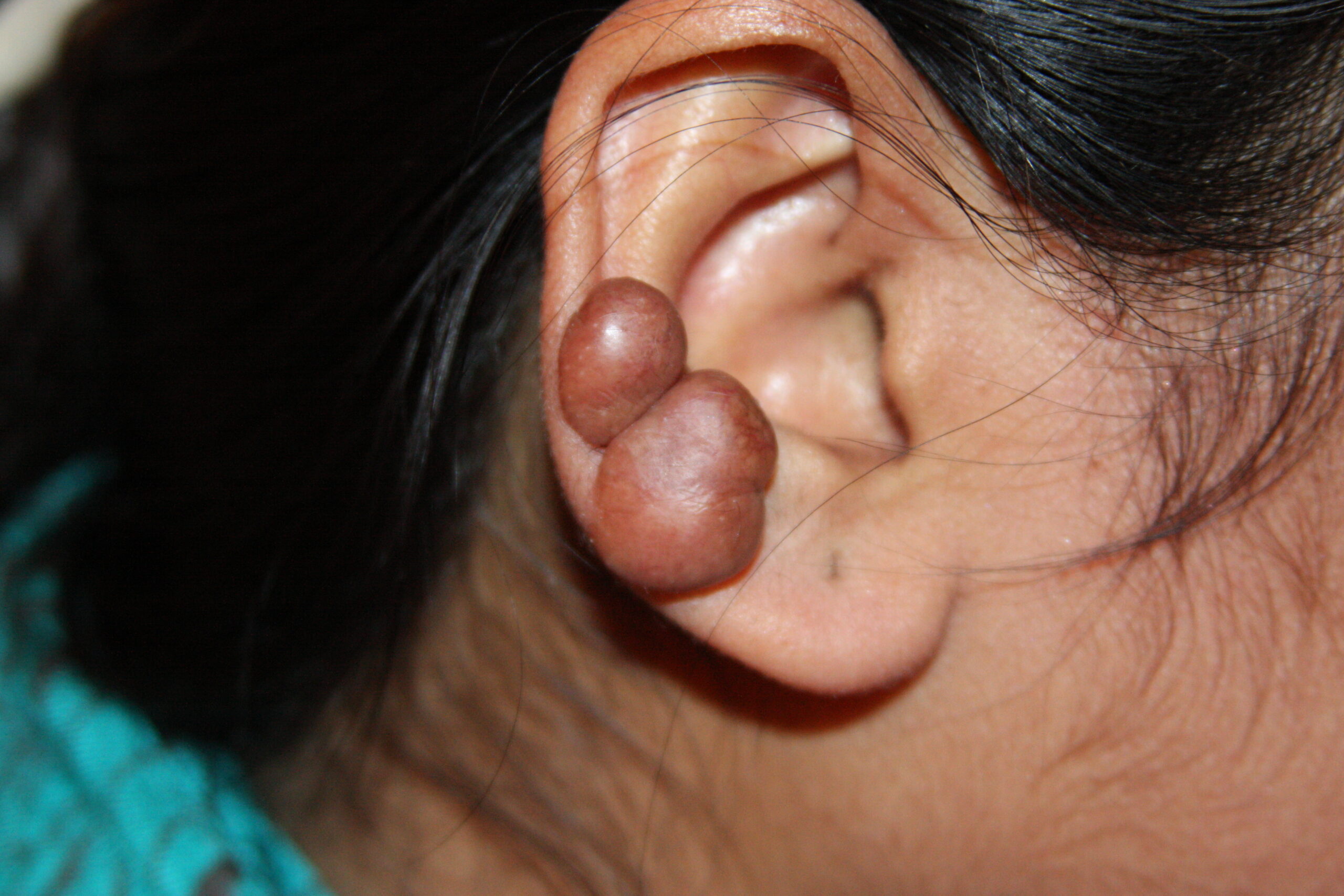 Ear Keloid