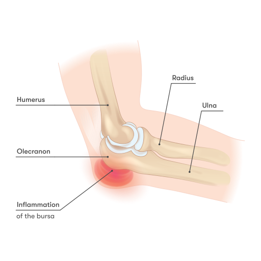 Inflammation of the bursa of the elbow, characterized by redness, swelling and pain at the tip of the elbow. Loss of function can also occur.