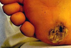 Example of an electrical burn