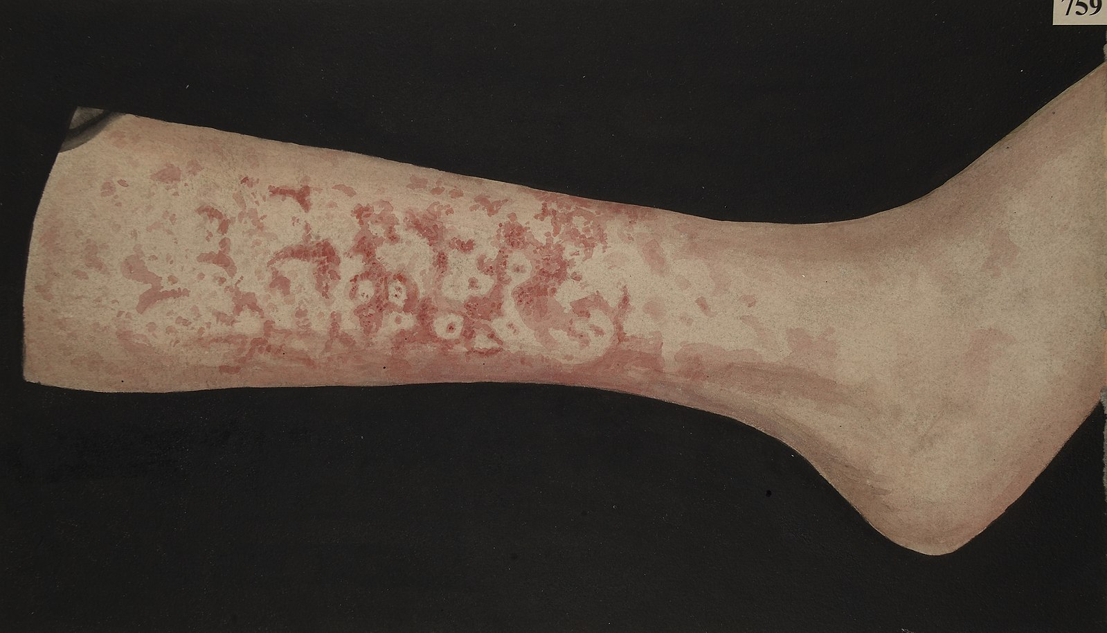 Leg with erythema marginatum