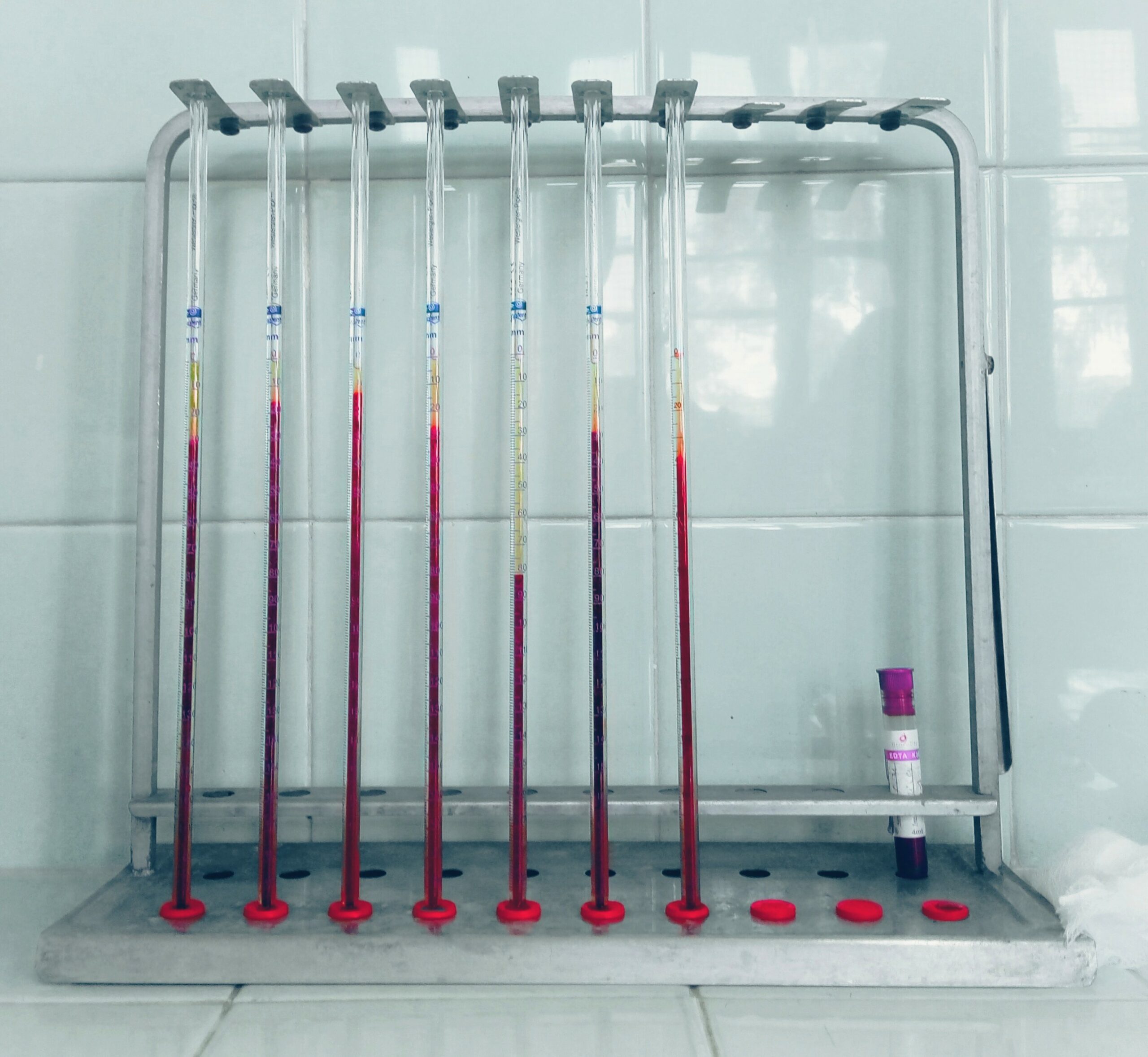 The erythrocyte sedimentation rate (ESR) is the rate at which red blood cells in anticoagulated whole blood descend in a standardized tube over a period of one hour.